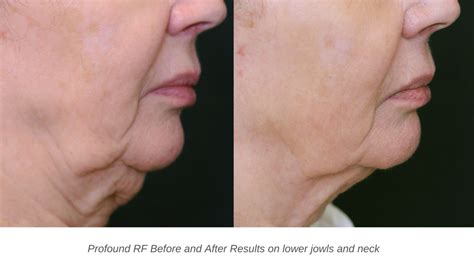 skin tightening greenwich|Profound RF Skin Tightening .